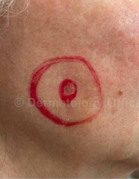 SRT-100 Before and After Case 74 Before