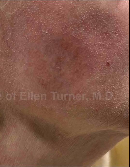 SRT-100 Before and After Case 74 After