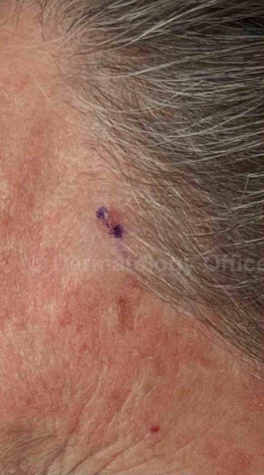 SRT-100 Before and After Case 71 Before