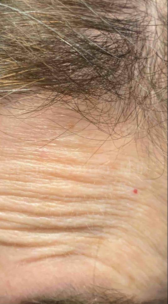 SRT-100 Before and After Case 69 After