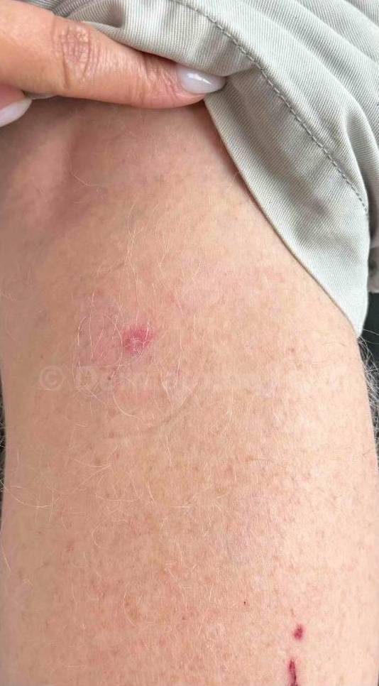 SRT-100 Before and After Case 68 Before