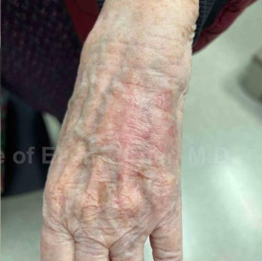 SRT-100 Before and After Case 67 After