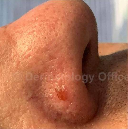 SRT-100 Before and After Case 66 Before