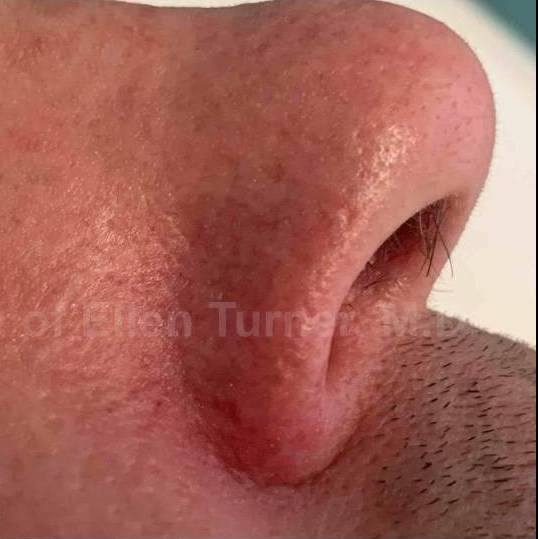 SRT-100 Before and After Case 66 After