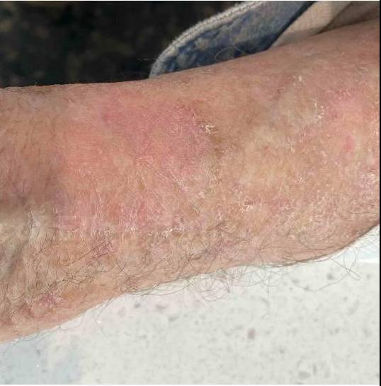 SRT-100 Before and After Case 65 After