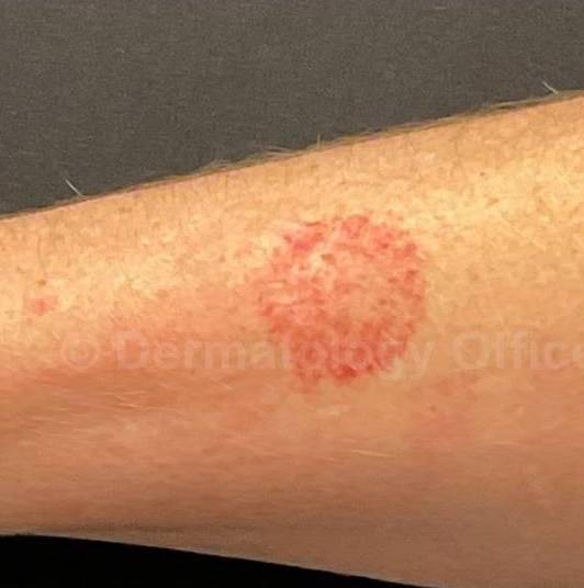 SRT-100 Before and After Case 62 Before