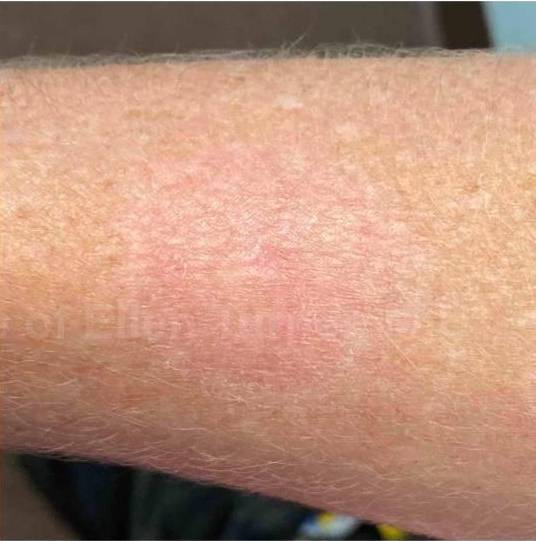 SRT-100 Before and After Case 62 After