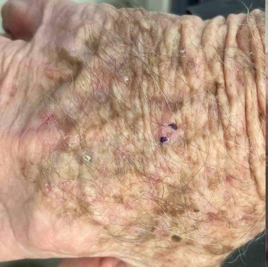 SRT-100 Before and After Case 61 Before