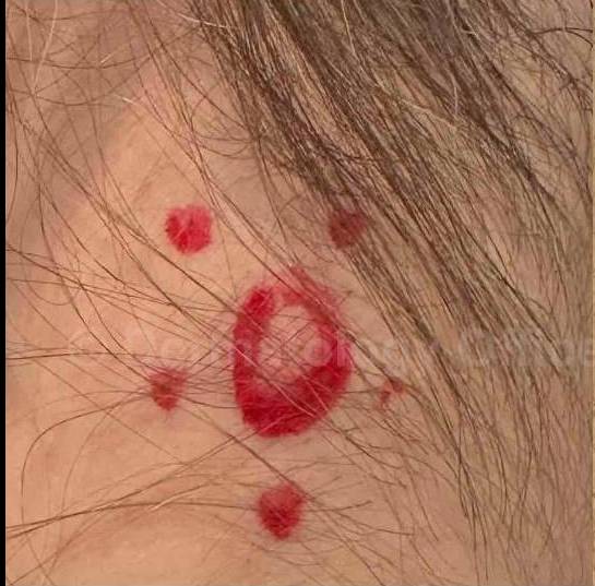 SRT-100 Before and After Case 60 Before