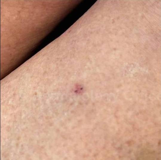 SRT-100 Before and After Case 59 Before