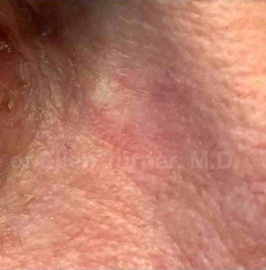 SRT-100 Before and After Case 58 After