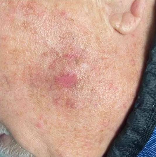 SRT-100 Before and After Case 57 After