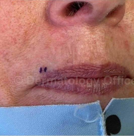 SRT-100 Before and After Case 56 Before