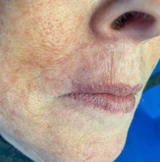 SRT-100 Before and After Case 56 After