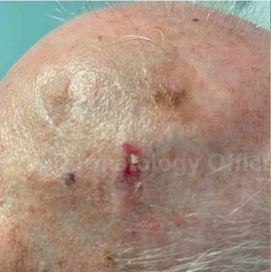 SRT-100 Before and After Case 55 Before