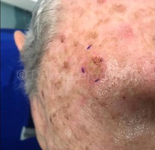 SRT-100 Before and After Case 54 Before