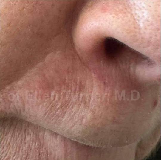 SRT-100 Before and After Case 53 After