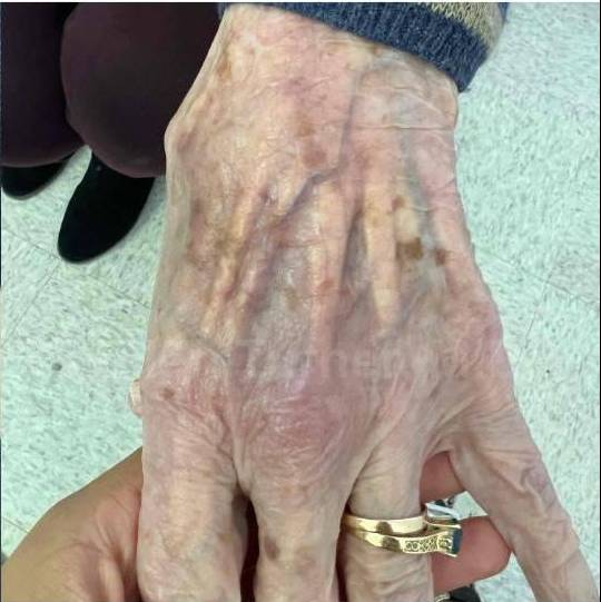 SRT-100 Before and After Case 52 After