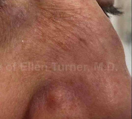 SRT-100 Before and After Case 51 After