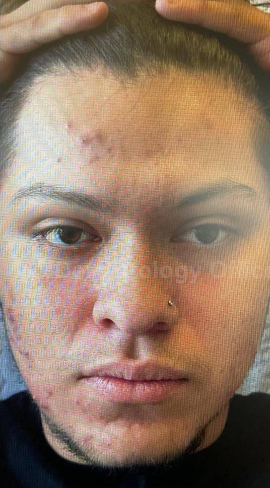 Acne Before and After Case-23 Before