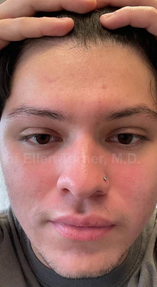 Acne Before and After Case-23 After