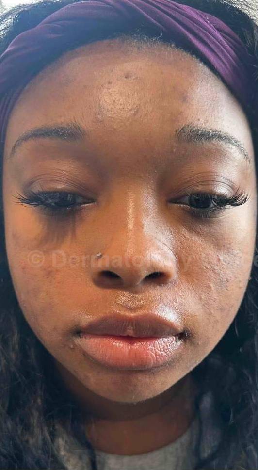 Acne Before and After Case-24 Before