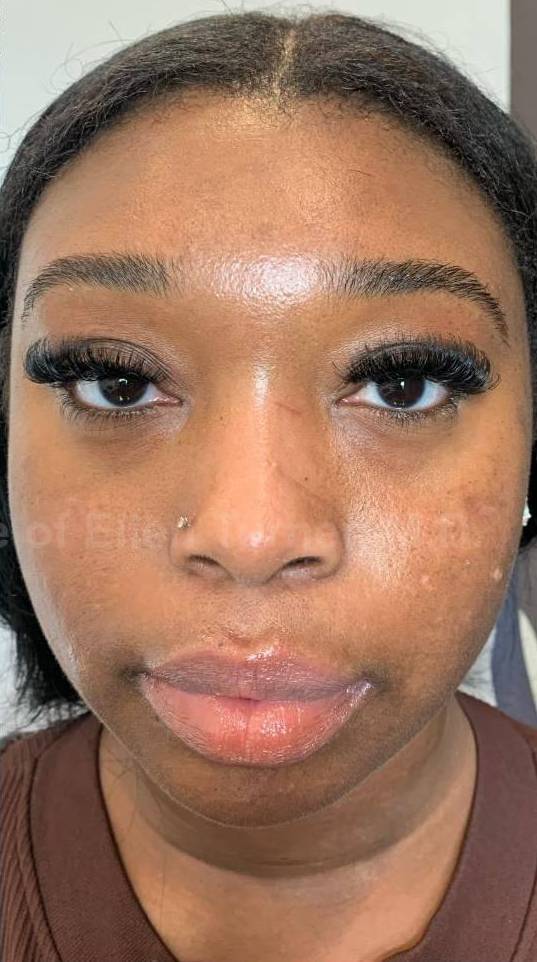 Acne Before and After Case-24 After