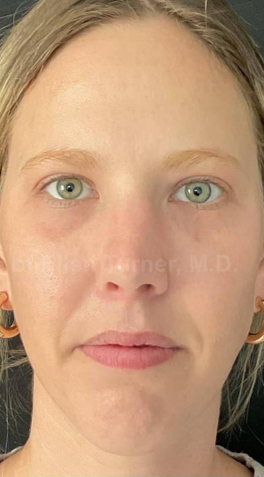 Acne Before and After Case-25 After