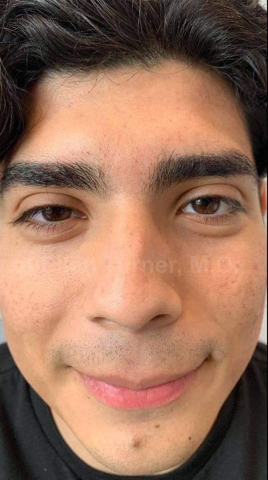 Acne Before and After Case-26 After