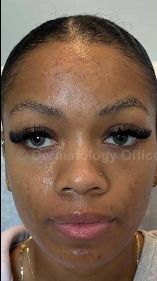 Acne Before and After Case-27 Before