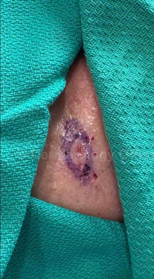 Cyst Removal Before and After Case-41 Before