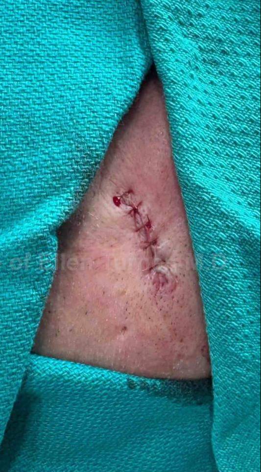 Cyst Removal Before and After Case-41 After