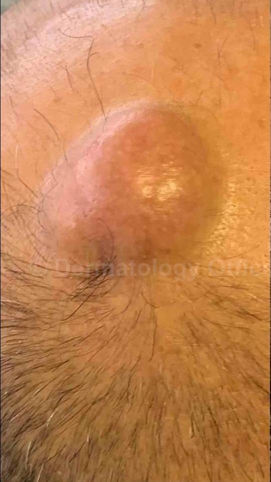 Cyst Removal Before and After Case-40 Before
