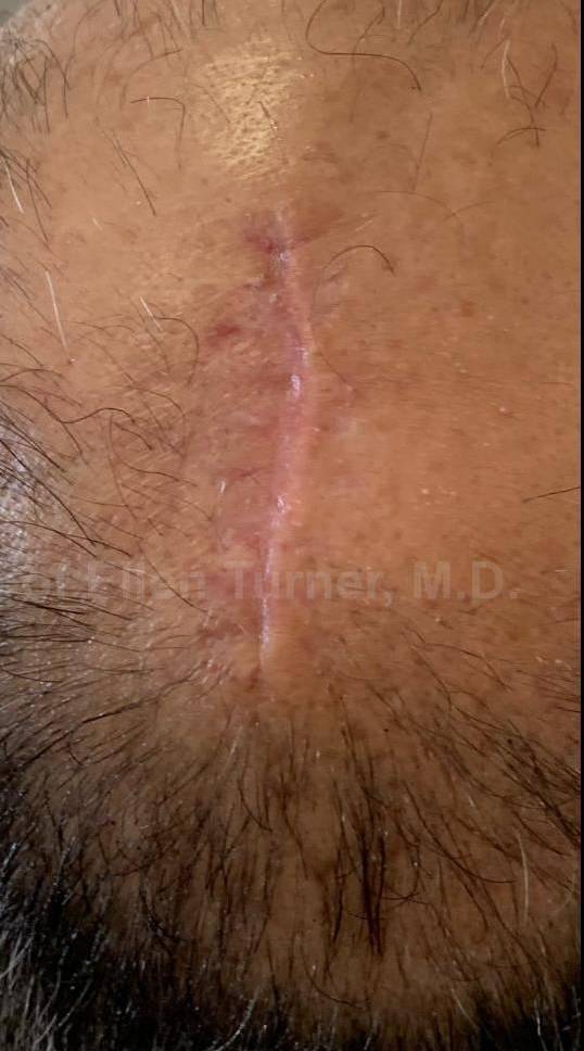 Cyst Removal Before and After Case-40 After