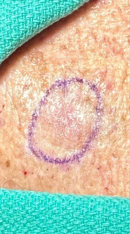 Cyst Removal Before and After Case-42 Before