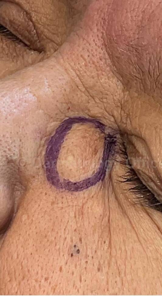 Cyst Removal Before and After Case-44 Before