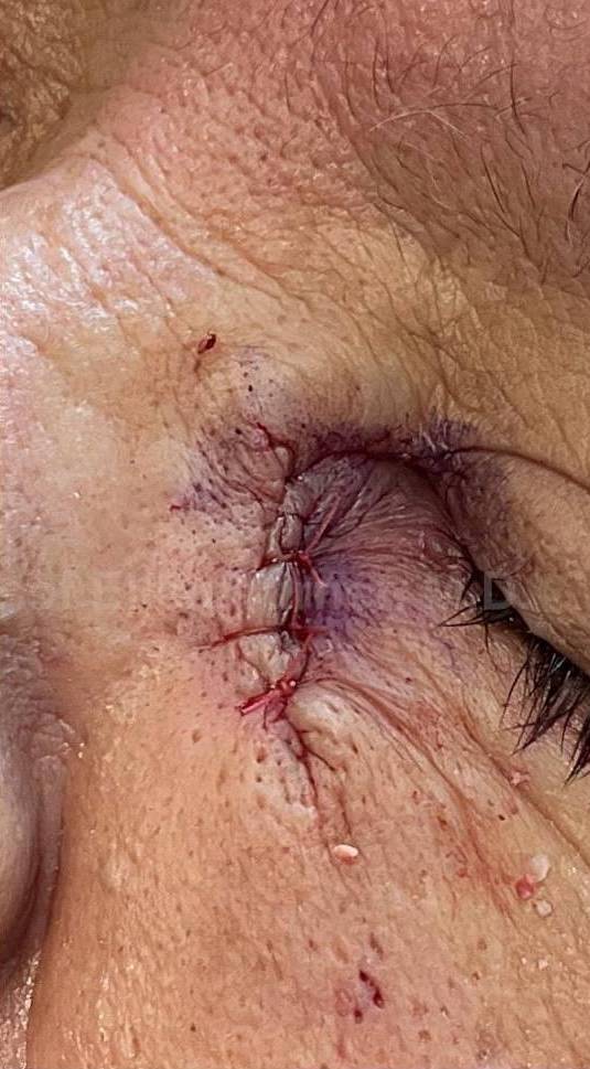 Cyst Removal Before and After Case-44 After