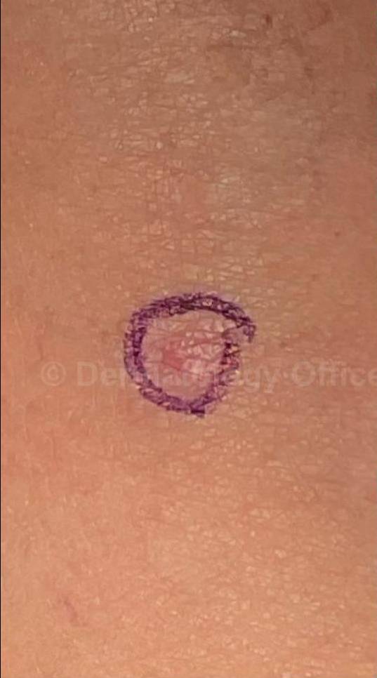 Cyst Removal Before and After Case-43 Before