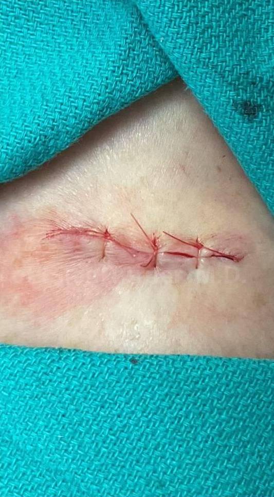 Cyst Removal Before and After Case-43 After