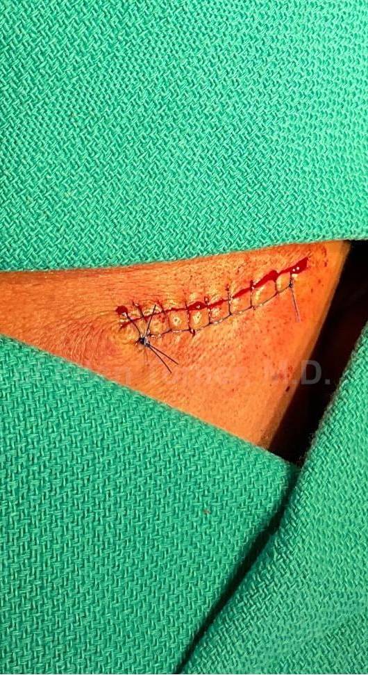 Cyst Removal Before and After Case-45 After