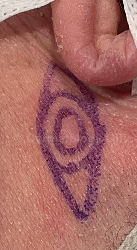 Cyst Removal Before and After Case-46 Before