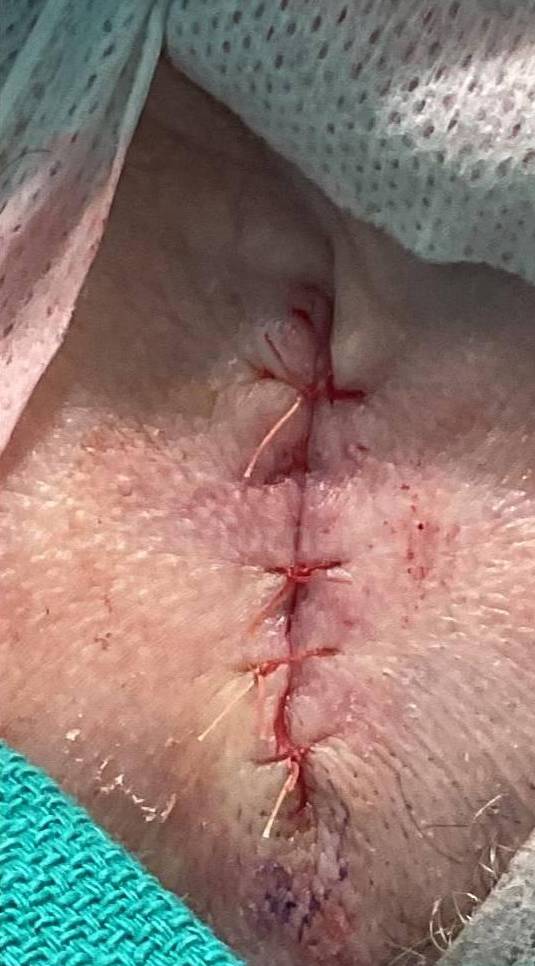 Cyst Removal Before and After Case-46 After