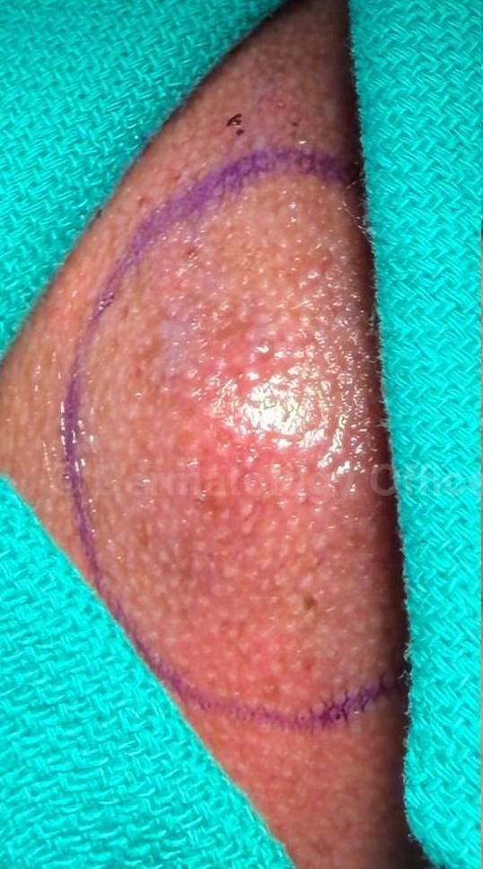 Cyst Removal Before and After Case-56 Before