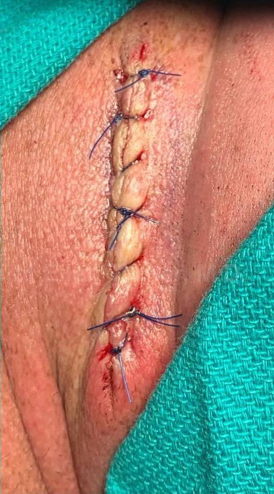 Cyst Removal Before and After Case-56 After