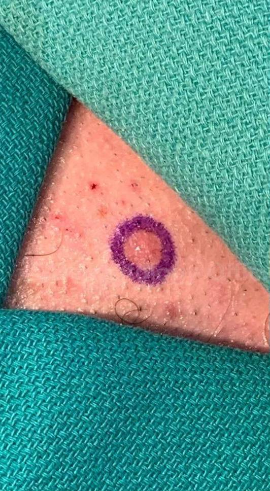 Cyst Removal Before and After Case-55 Before