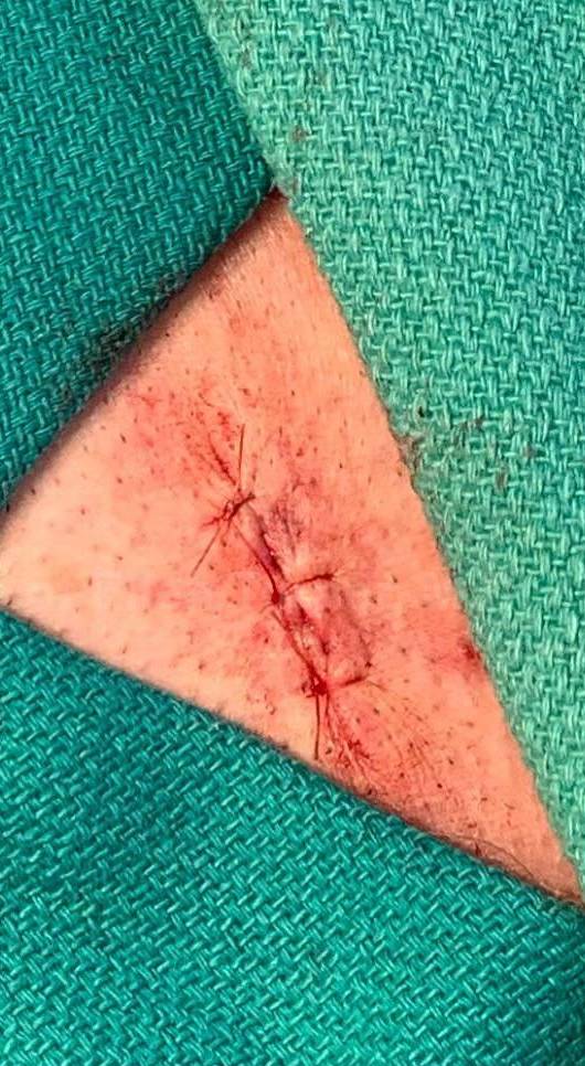 Cyst Removal Before and After Case-55 After