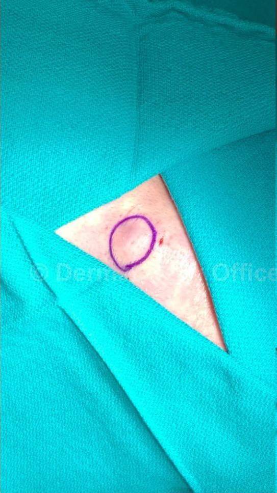 Cyst Removal Before and After Case-54 Before