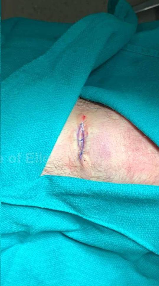 Cyst Removal Before and After Case-54 After