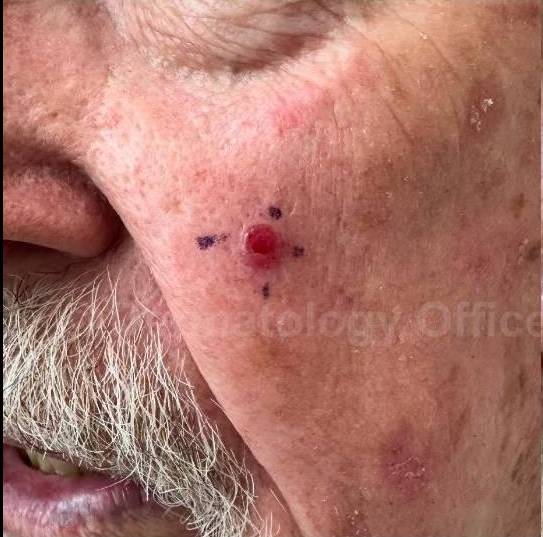 Cyst Removal Before and After Case-53 Before