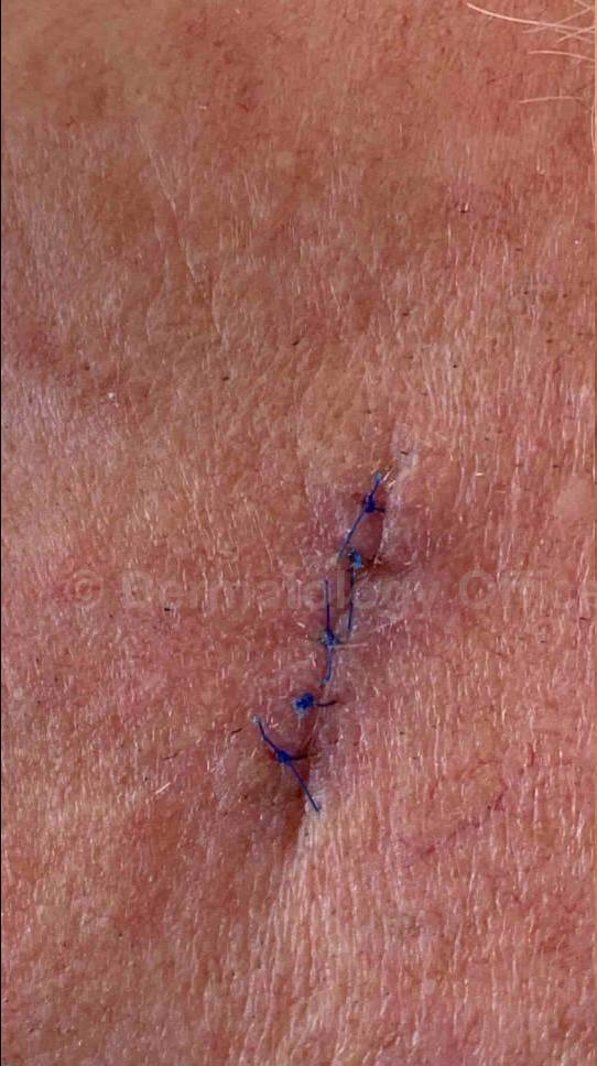 Cyst Removal Before and After Case-48 Before